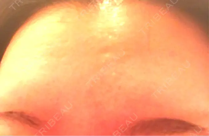 ボトックス（額） 湘南美容クリニック 名古屋栄院 DAY 6 メイン用