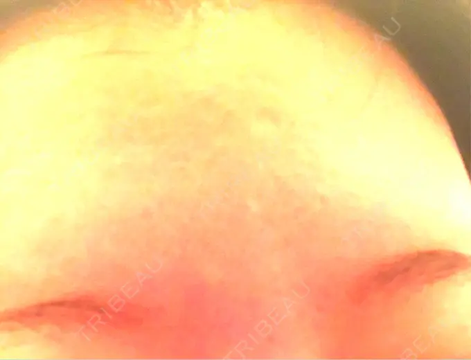 ボトックス（額） 湘南美容クリニック 名古屋栄院 DAY 7 メイン用