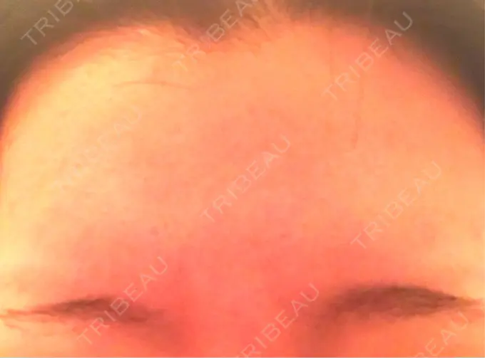 ボトックス（額） 湘南美容クリニック 名古屋栄院 DAY 8 メイン用