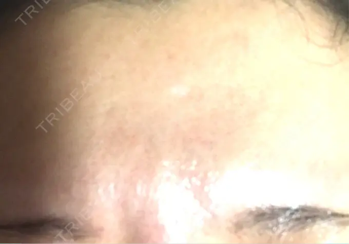 ボトックス（額） 湘南美容クリニック 名古屋栄院 DAY 9 メイン用