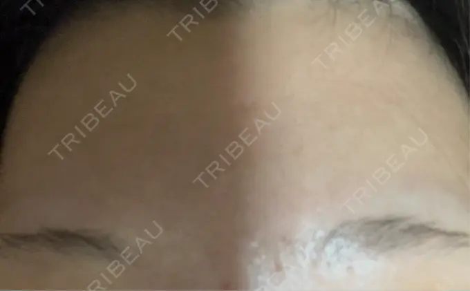 ボトックス（額） 湘南美容クリニック 名古屋栄院 AFTER メイン用