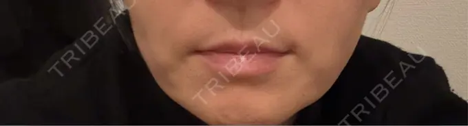 ヒアルロン酸注入（鼻翼基部） ルラ美容クリニック 渋谷本院 DAY 9 メイン用