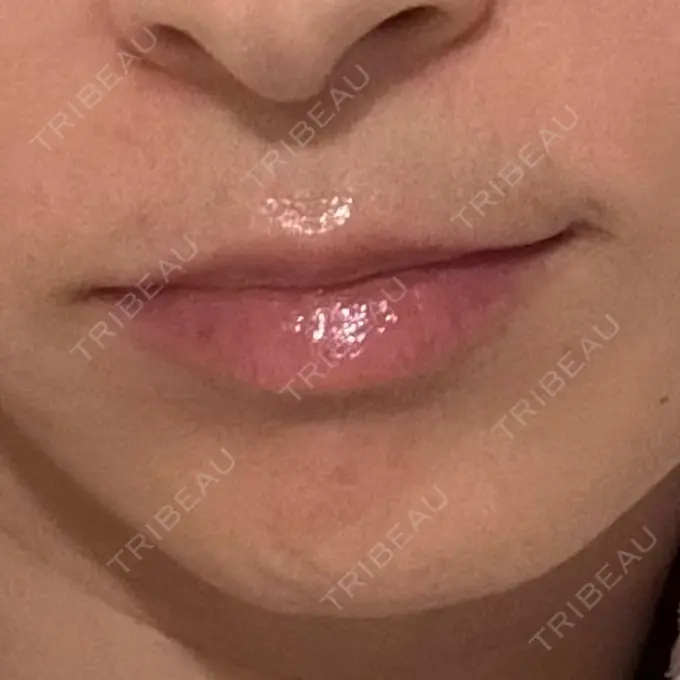 ヒアルロン酸注入（鼻翼基部） ルラ美容クリニック 渋谷本院 DAY 10 メイン用