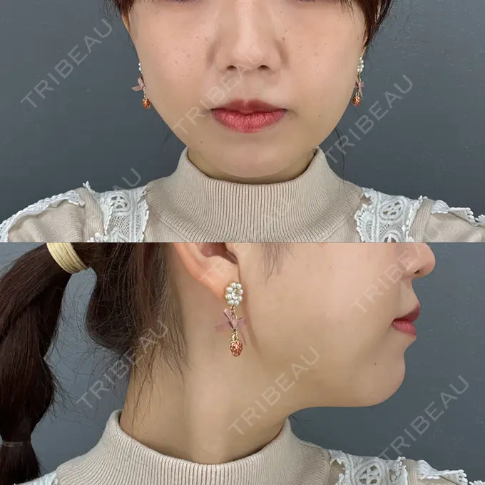 糸リフト / 脂肪吸引（顔） / 脂肪吸引注射（顔） ziz CLINIC AFTER メイン用