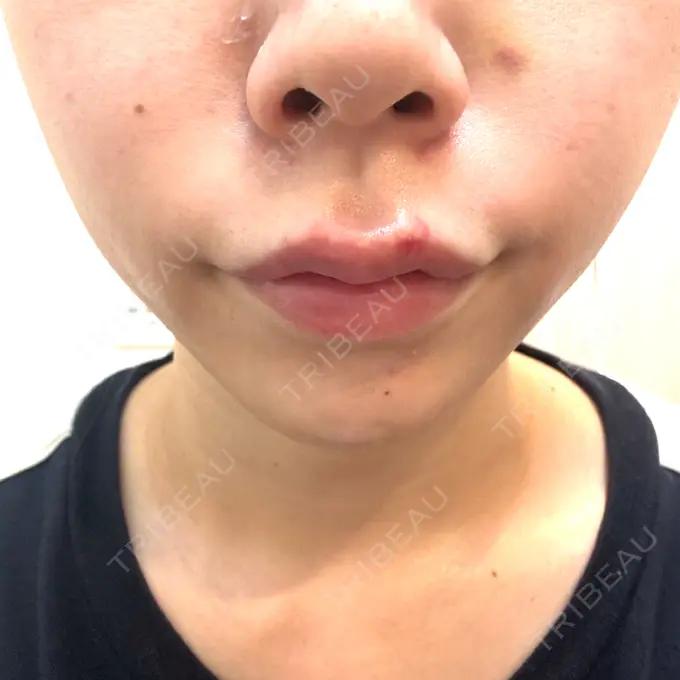 ヒアルロン酸注入（唇） / ボトックス（口角） ルラ美容クリニック 大阪本院 DAY 3 メイン用