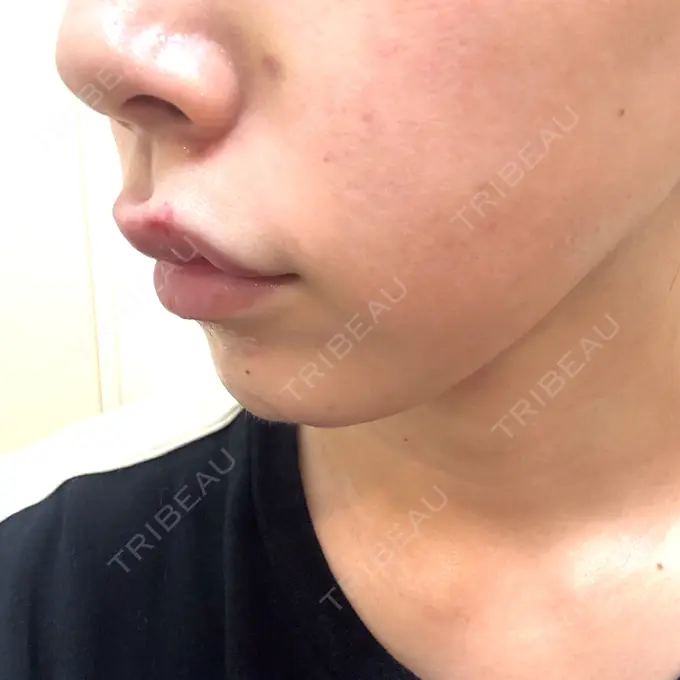 ヒアルロン酸注入（唇） / ボトックス（口角） ルラ美容クリニック 大阪本院 DAY 3 メイン用