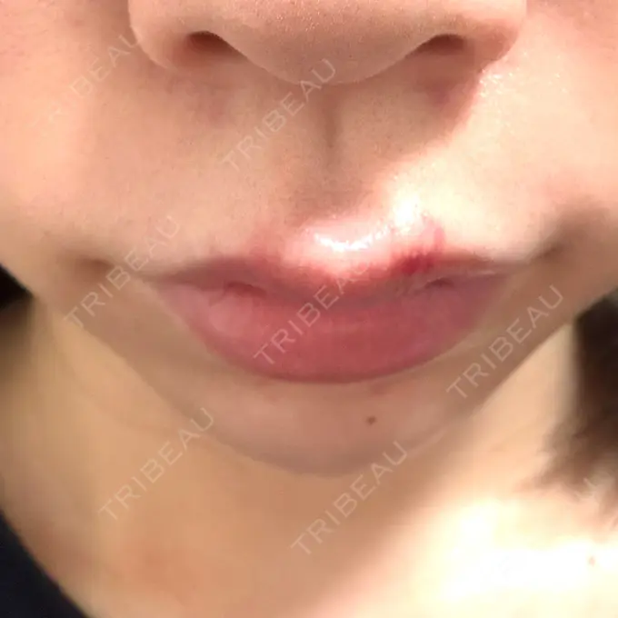 ヒアルロン酸注入（唇） / ボトックス（口角） ルラ美容クリニック 大阪本院 DAY 4 メイン用