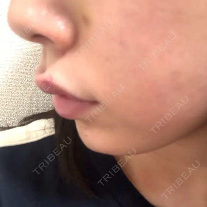 ヒアルロン酸注入（唇） / ボトックス（口角） ルラ美容クリニック 大阪本院 DAY 4 メイン用