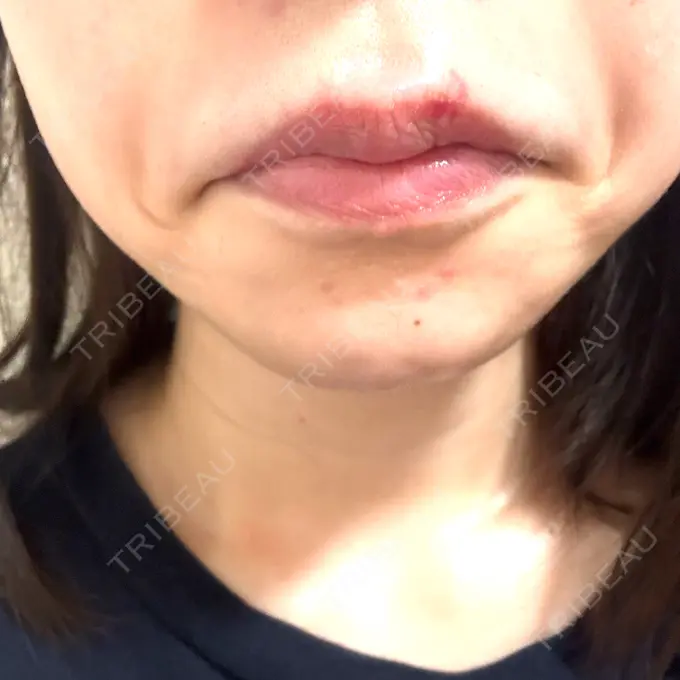 ヒアルロン酸注入（唇） / ボトックス（口角） ルラ美容クリニック 大阪本院 DAY 4 メイン用