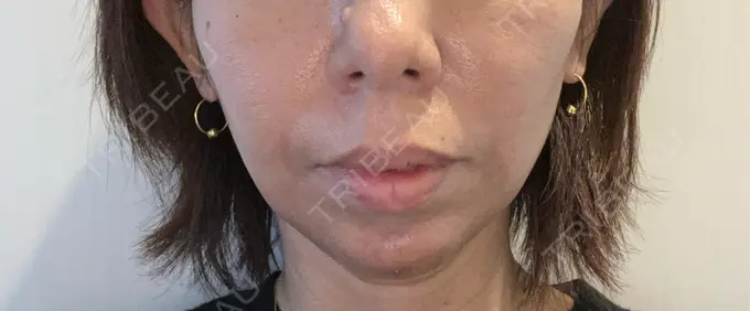 ボトックス（あご） / ヒアルロン酸注入（あご） / ヒアルロン酸注入（頬） HAAB BEAUTY CLINIC 名古屋院 DAY 2 メイン用