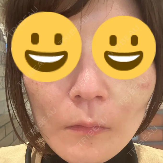 糸リフト SK新宿歌舞伎町美容外科・歯科 DAY 0 メイン用