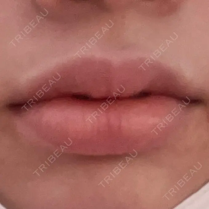 ボトックス（口角） 小倉美容外科/美容皮膚科 ビラビューティークリニック DAY 0 メイン用