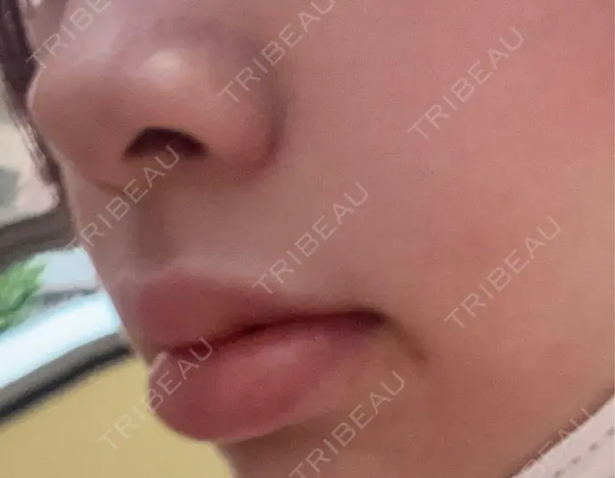 ボトックス（口角） 小倉美容外科/美容皮膚科 ビラビューティークリニック DAY 0 メイン用