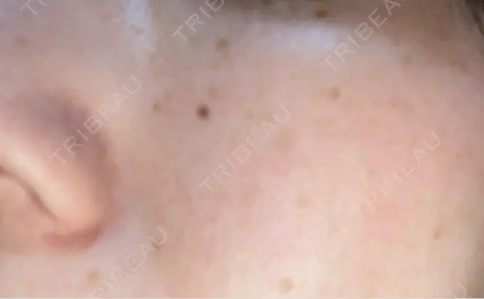 エレクトロポレーション / ピーリング（ハリ・ツヤ） ルラ美容クリニック 仙台院 / ルラスキンクリニック 仙台院 AFTER メイン用