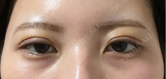 二重埋没 / 上まぶたの脂肪取り アリエル美容クリニック 横浜院 DAY 3 メイン用