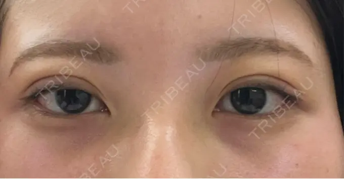 二重埋没 / 上まぶたの脂肪取り アリエル美容クリニック 横浜院 DAY 4 メイン用