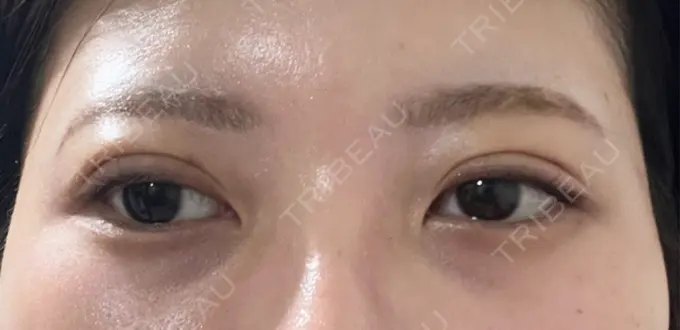 二重埋没 / 上まぶたの脂肪取り アリエル美容クリニック 横浜院 DAY 5 メイン用