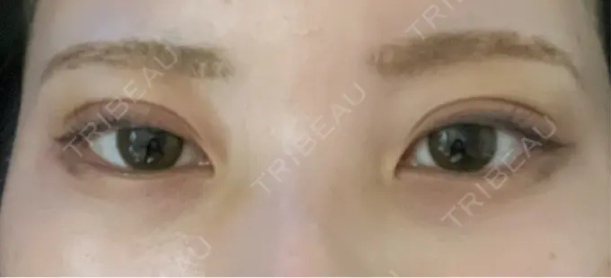 二重埋没 / 上まぶたの脂肪取り アリエル美容クリニック 横浜院 DAY 6 メイン用