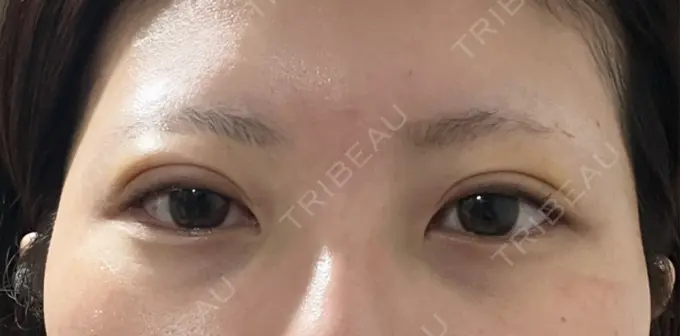 二重埋没 / 上まぶたの脂肪取り アリエル美容クリニック 横浜院 AFTER メイン用