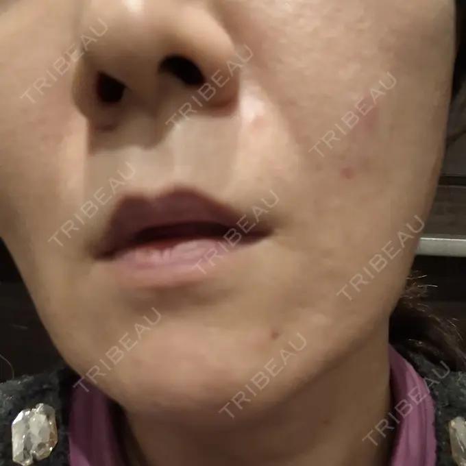 ボトックス（額） / ピコスポット 東京ココセランクリニック DAY 0 メイン用