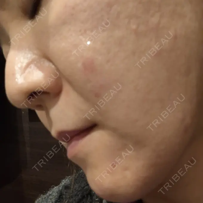 ボトックス（額） / ピコスポット 東京ココセランクリニック DAY 0 メイン用