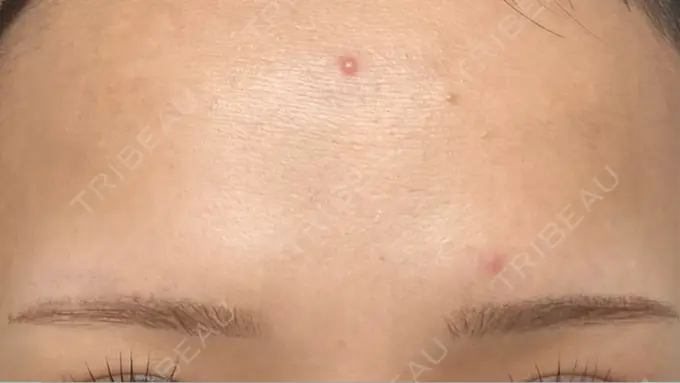 アートメイク（眉） / アートメイク（唇） Tokyo Tensei Clinic 新宿院 DAY 9 メイン用