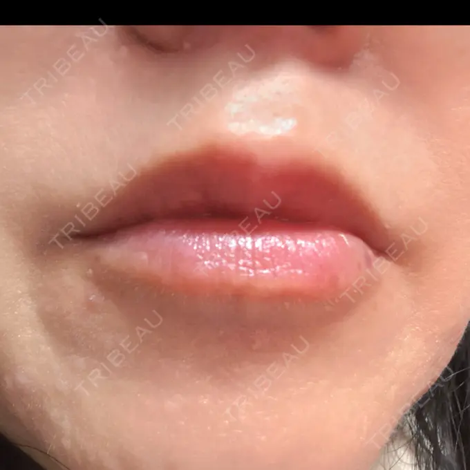 ヒアルロン酸注入（唇） 目白ホワイトクリニック DAY 4 メイン用