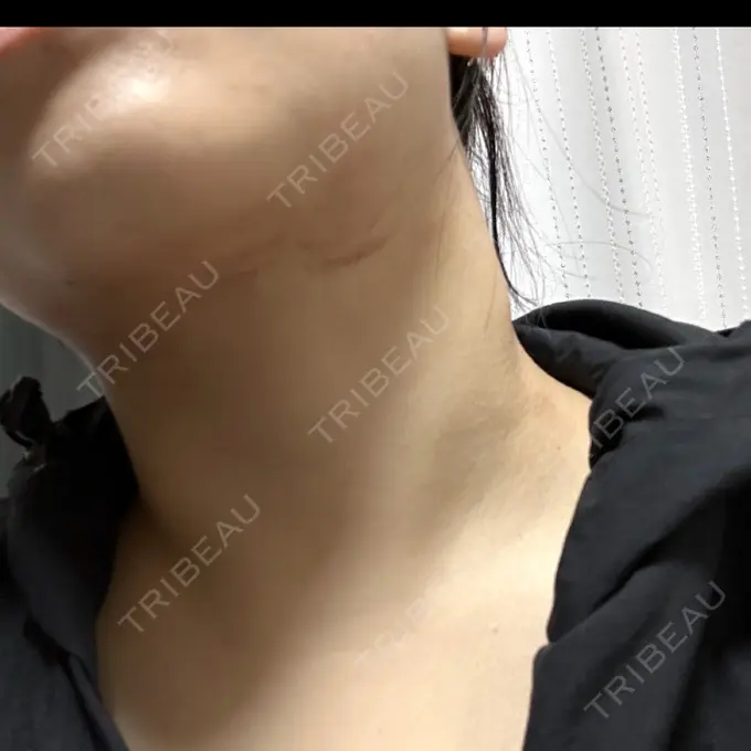 RF（高周波）たるみ治療 ゆきスキンクリニック 東池袋 AFTER メイン用