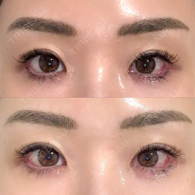 目尻切開 / タレ目形成・グラマラスライン（埋没） LOUIS CLINIC 二子玉川院【ルイクリニック】 DAY 2 メイン用