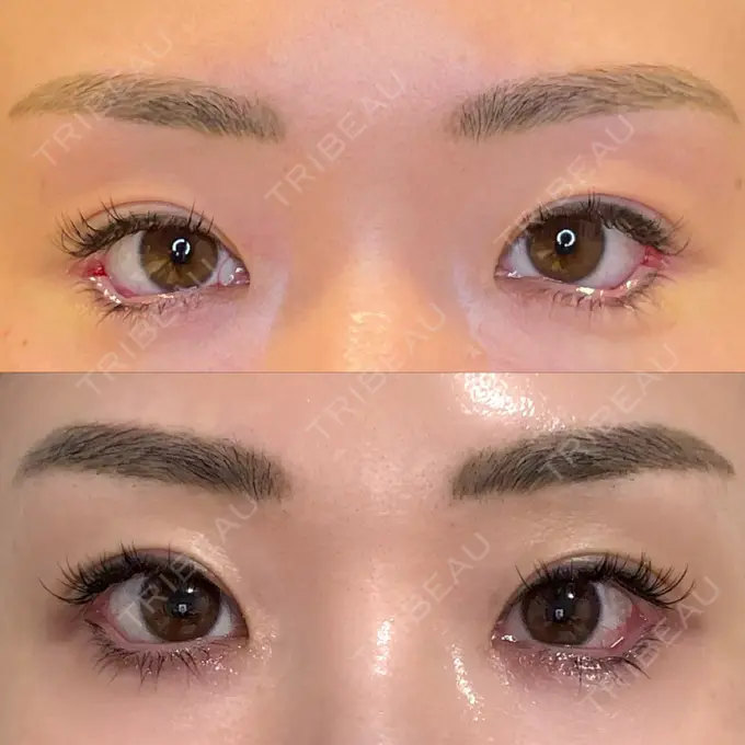 目尻切開 / タレ目形成・グラマラスライン（埋没） LOUIS CLINIC 二子玉川院【ルイクリニック】 DAY 1 メイン用