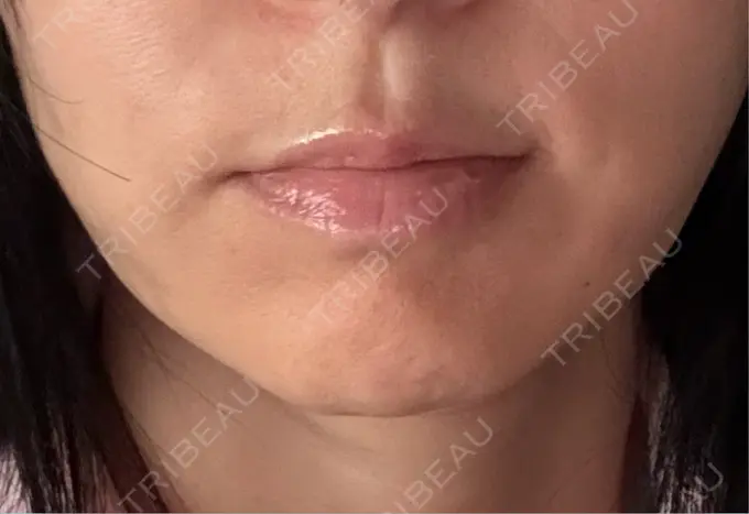 ヒアルロン酸注入（鼻翼基部） ルラ美容クリニック 渋谷本院 AFTER メイン用