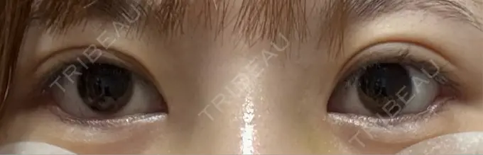 目尻切開 / タレ目形成・グラマラスライン（埋没） LOUIS CLINIC 二子玉川院【ルイクリニック】 DAY 5 メイン用