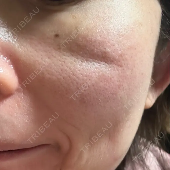 糸リフト SK新宿歌舞伎町美容外科・歯科 DAY 1 メイン用