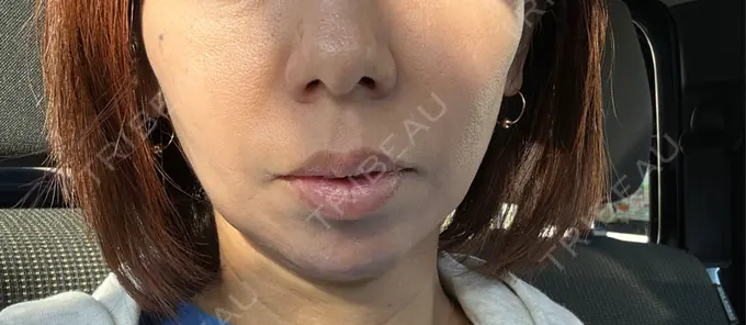 ボトックス（あご） / ヒアルロン酸注入（あご） / ヒアルロン酸注入（頬） HAAB BEAUTY CLINIC 名古屋院 DAY 4 メイン用