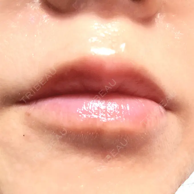 ヒアルロン酸注入（唇） 目白ホワイトクリニック DAY 5 メイン用