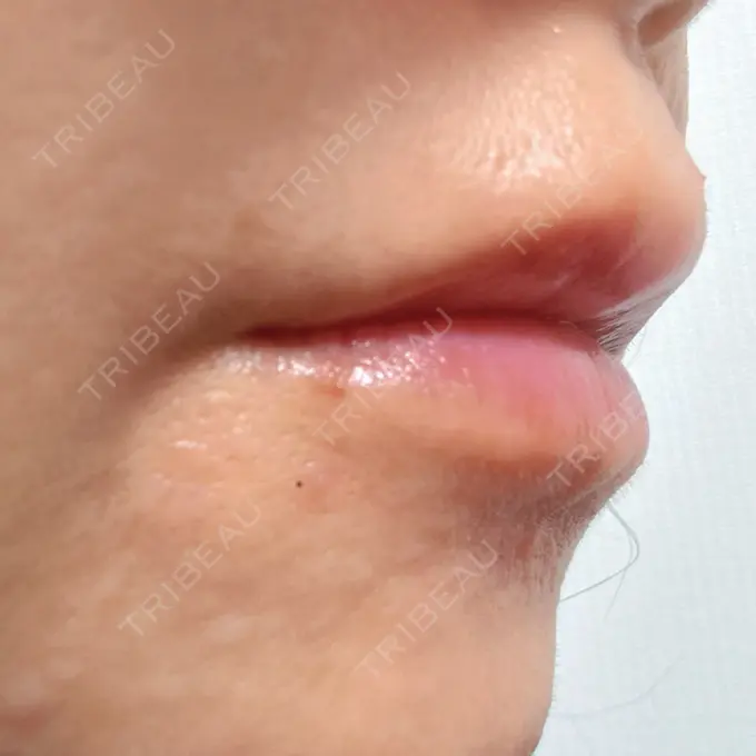 ヒアルロン酸注入（唇） 目白ホワイトクリニック DAY 5 メイン用