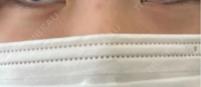 ヒアルロン酸注入（涙袋） 共立美容外科 梅田院 DAY 0 メイン用