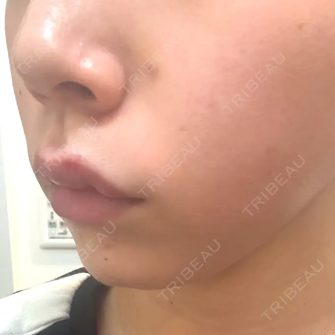 ヒアルロン酸注入（唇） / ボトックス（口角） ルラ美容クリニック 大阪本院 DAY 5 メイン用