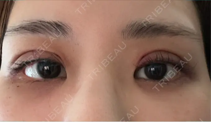 二重埋没 WOM CLINIC GINZA （ワム クリニック ギンザ） DAY 1 メイン用