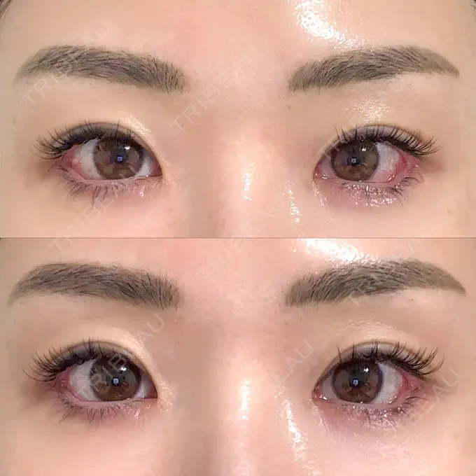 目尻切開 / タレ目形成・グラマラスライン（埋没） LOUIS CLINIC 二子玉川院【ルイクリニック】 DAY 3 メイン用