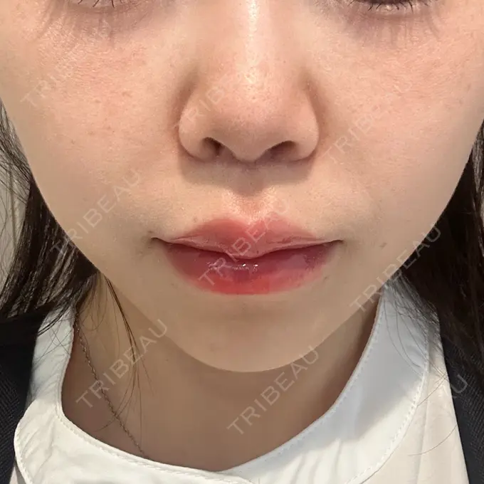 人中短縮 / ヒアルロン酸注入（目の下） / RF（高周波）たるみ治療 BITO BEAUTY CLINIC AFTER メイン用