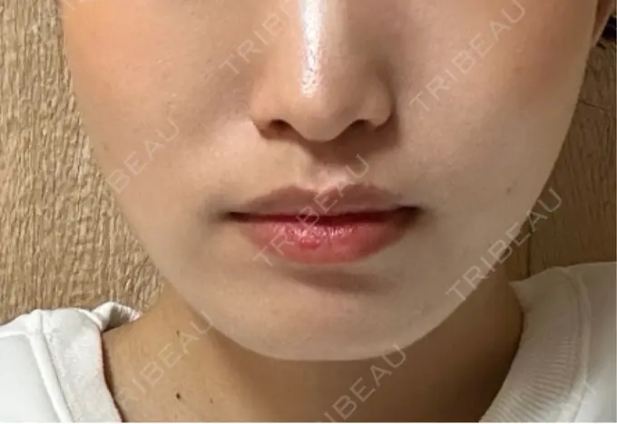 糸リフト / ヒアルロン酸注入（頬） 東京シンデレラ美容外科 池袋院 DAY 2 メイン用