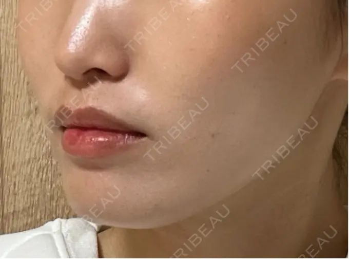 糸リフト / ヒアルロン酸注入（頬） 東京シンデレラ美容外科 池袋院 DAY 2 メイン用