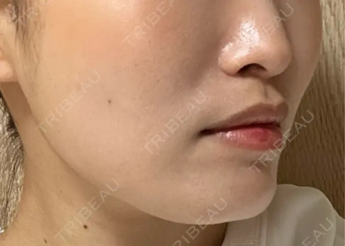 糸リフト / ヒアルロン酸注入（頬） 東京シンデレラ美容外科 池袋院 DAY 2 メイン用