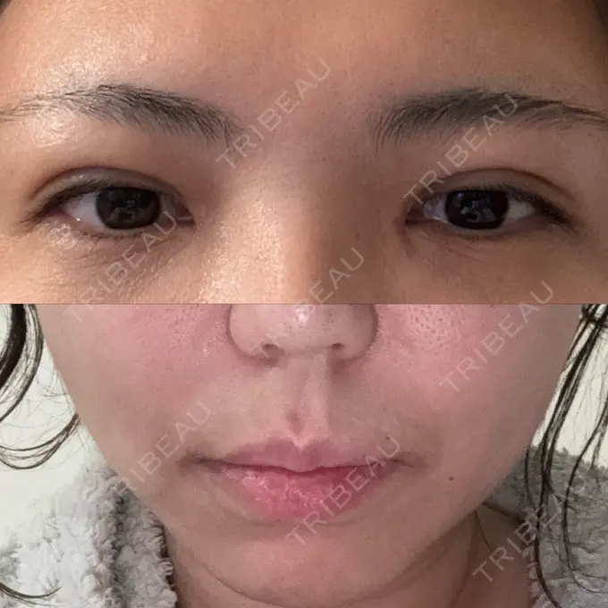 二重埋没 / 目頭切開 / 糸リフト / 鼻翼基部形成（貴族手術） / ヒアルロン酸注入（鼻翼基部） 東京シンデレラ美容外科 池袋院 DAY 10 メイン用