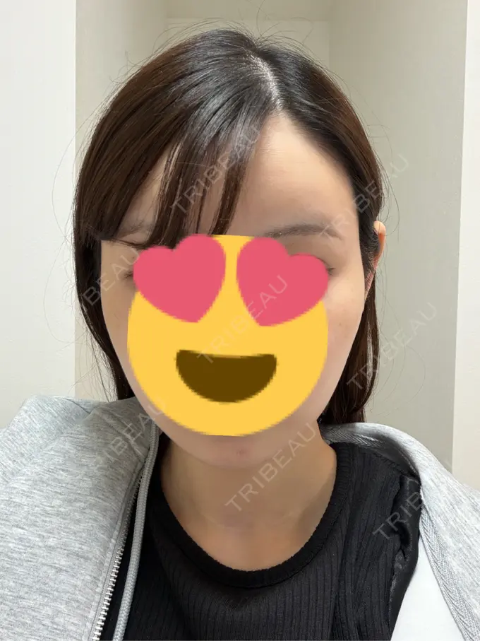 糸リフト / 脂肪吸引（顔） Mods Clinic（モッズクリニック） 名古屋院 DAY 183 メイン用