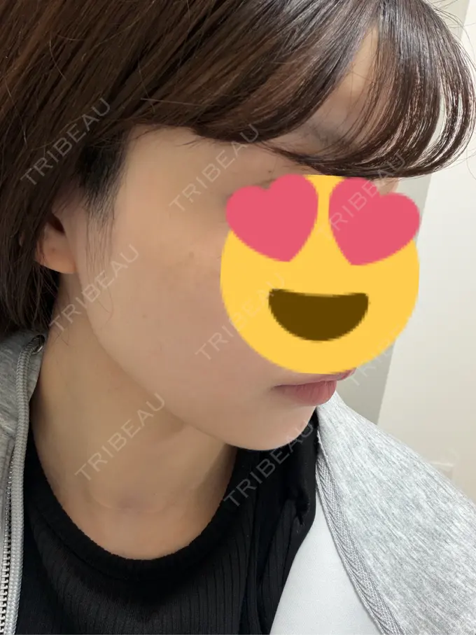 糸リフト / 脂肪吸引（顔） Mods Clinic（モッズクリニック） 名古屋院 DAY 183 メイン用