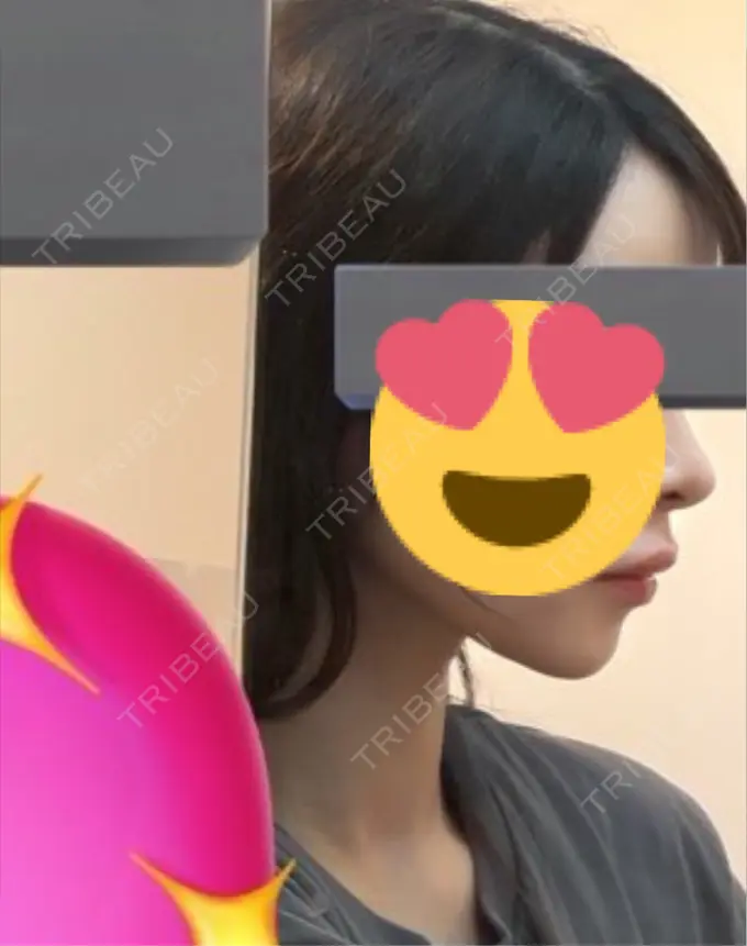 糸リフト / 脂肪吸引（顔） Mods Clinic（モッズクリニック） 名古屋院 AFTER メイン用