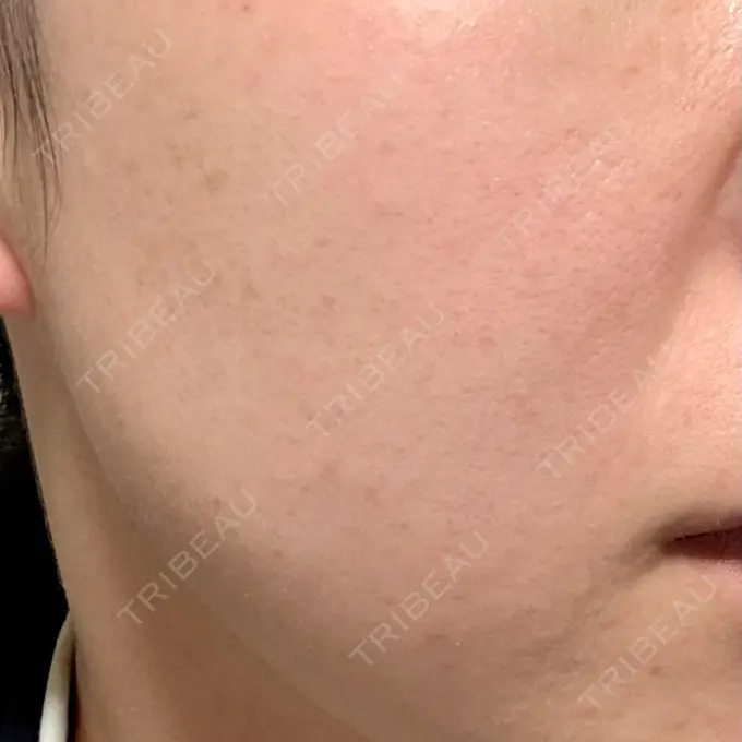 イオン導入 / 毛穴洗浄（ハイドラフェイシャルなど） / ルメッカ ルラ美容クリニック 仙台院 / ルラスキンクリニック 仙台院 AFTER メイン用