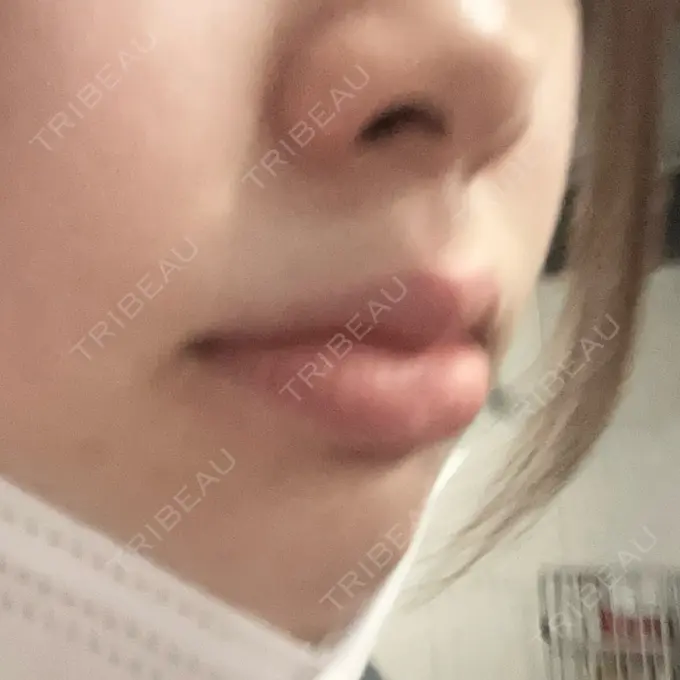 ボトックス（口角） 小倉美容外科/美容皮膚科 ビラビューティークリニック DAY 1 メイン用